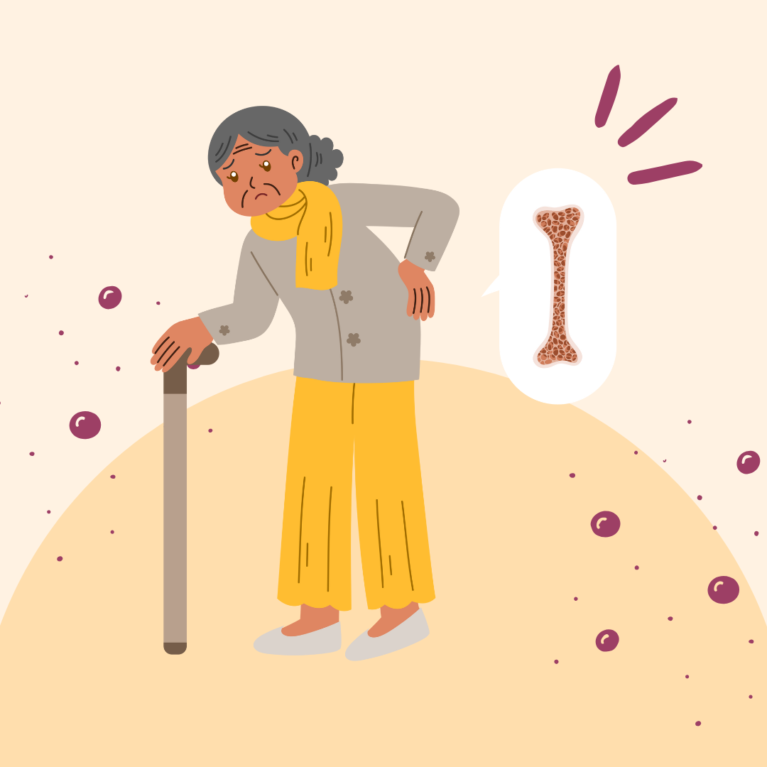 Preventing Osteoporosis: Best Practices for Bone Health